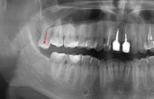 Верхний зуб мудрости после удаления нижнего перемещается вниз 