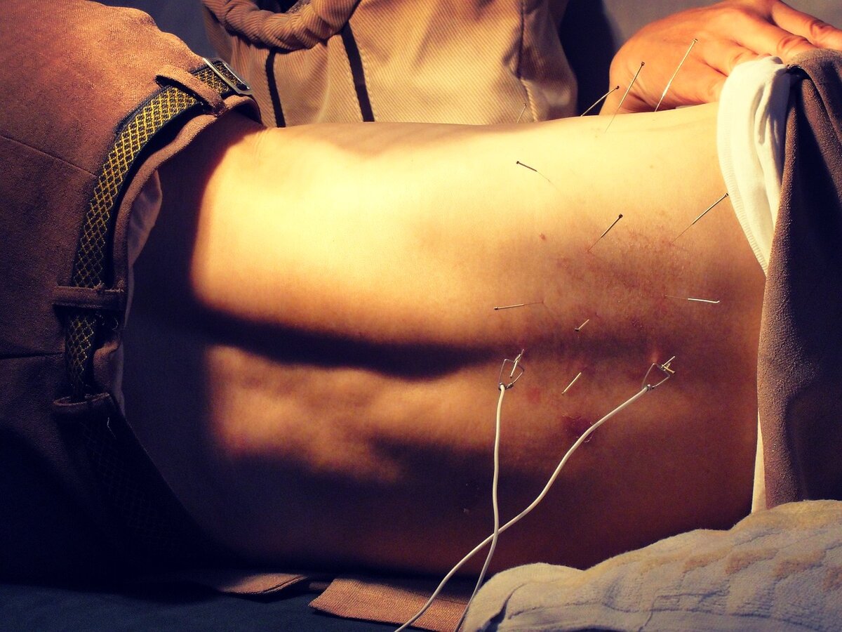 Иголки с электродами - выглядит страшно, но на деле - не больно