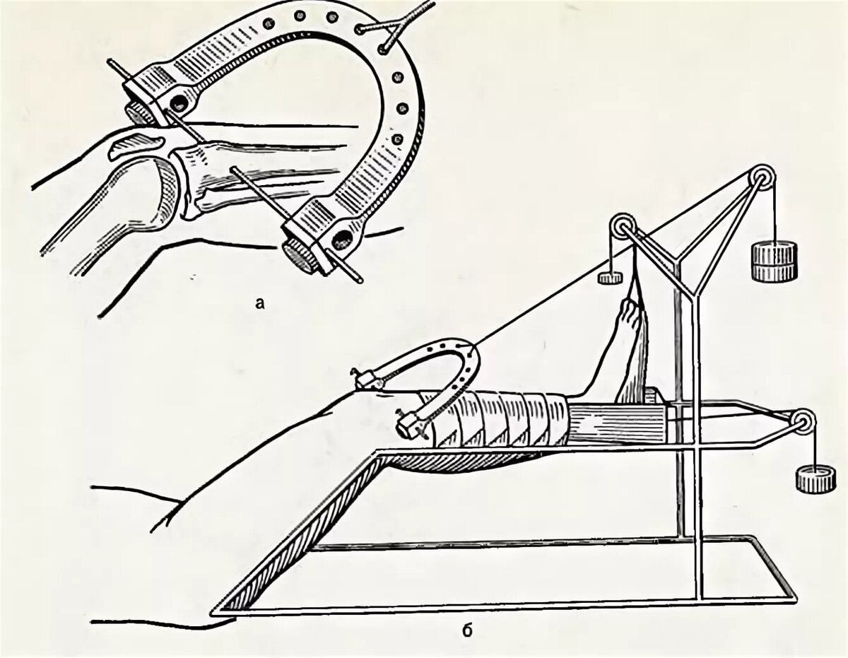 Скелетное вытяжение при переломе голени техника