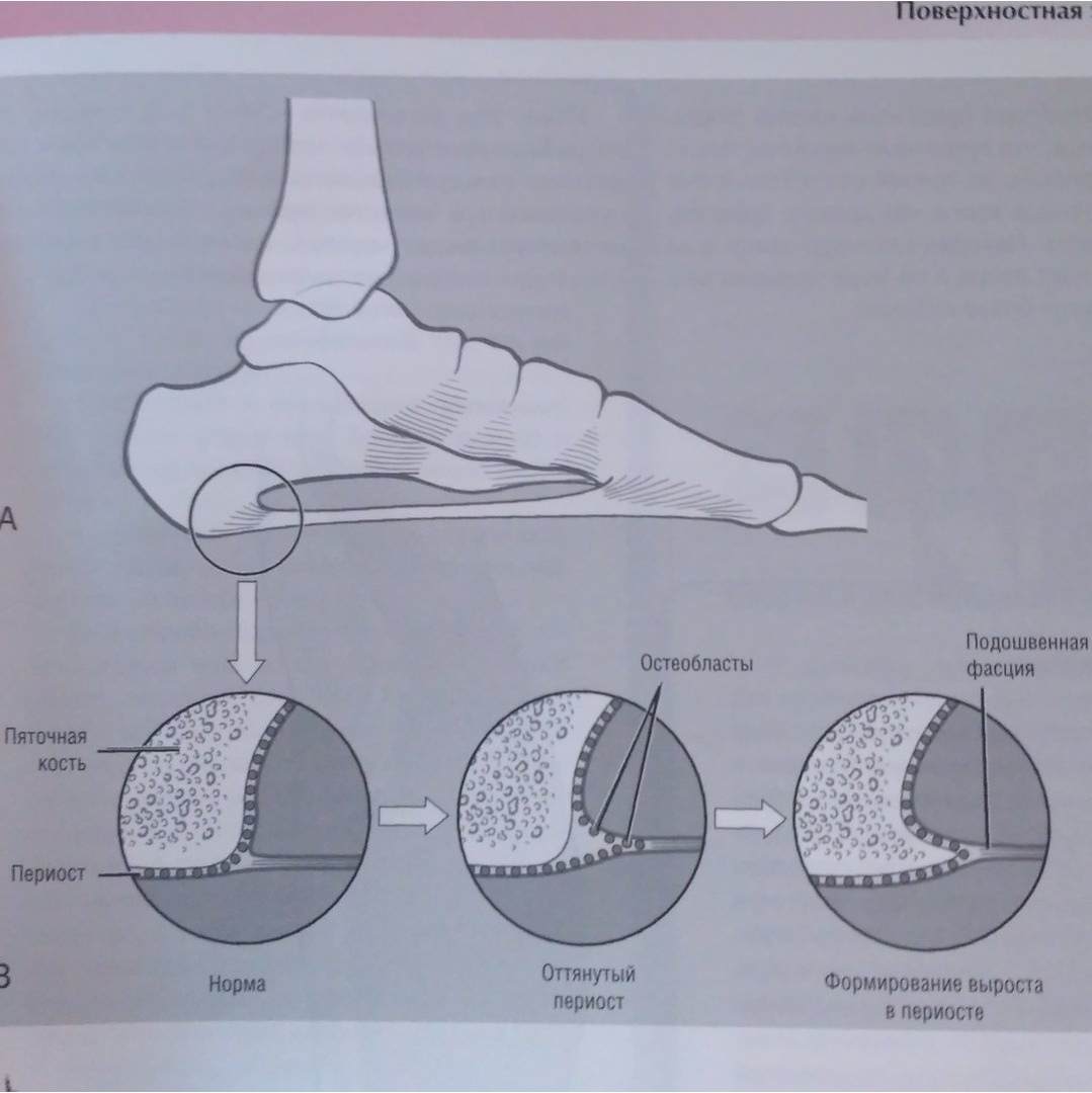 Отложение в пятке. Пяточные шпоры симптомы. Формирование пяточной шпоры. Как образуется шпора на пятке.