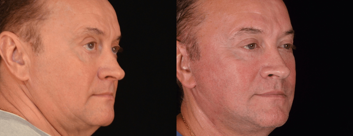 Выполнена хирургическая подтяжка лица МАКС лифт с укорочённым рубцом и вертикальным вектором натяжения. Имеются противопоказания, требуется консультация специалистов