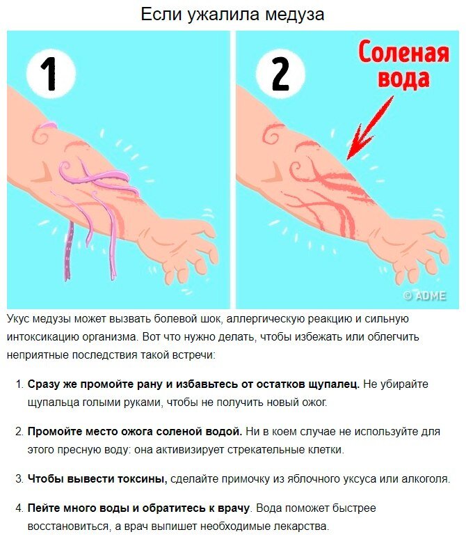 Сразу а через несколько. Первая помощь при укусе медузы.
