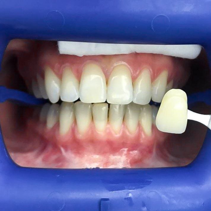 До. Профессиональной помощью при лазерном отбеливании или проведении других процедур следует воспользоваться всем, кто страдает от потемнения эмали.