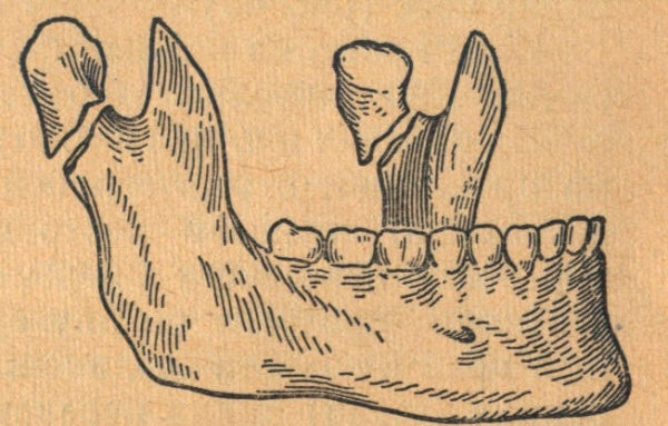 Перелом мыщелкового отростка нижней челюсти (именно от этой травмы и придумана каппа прежде всего)