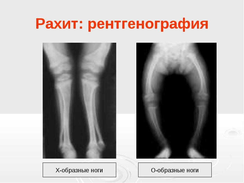 Рахит костей у детей. Рахит симптомы рентген. Рентген трубчатых костей при рахите. Рентгенологическая картина рахита. Рентгенологические изменения рахит.