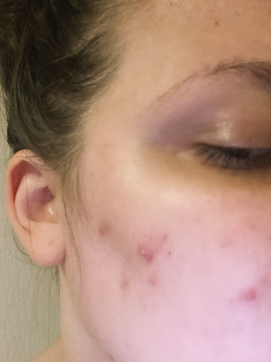 Утро после сыворотки.