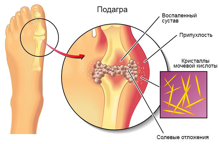 В случае, когда организм становится не способным использовать белки на собственные нужды (это нарушение пуринового обмена), то в организме начинают накапливаться продукты распада белка, конечным продуктом является мочевая кислота.  
