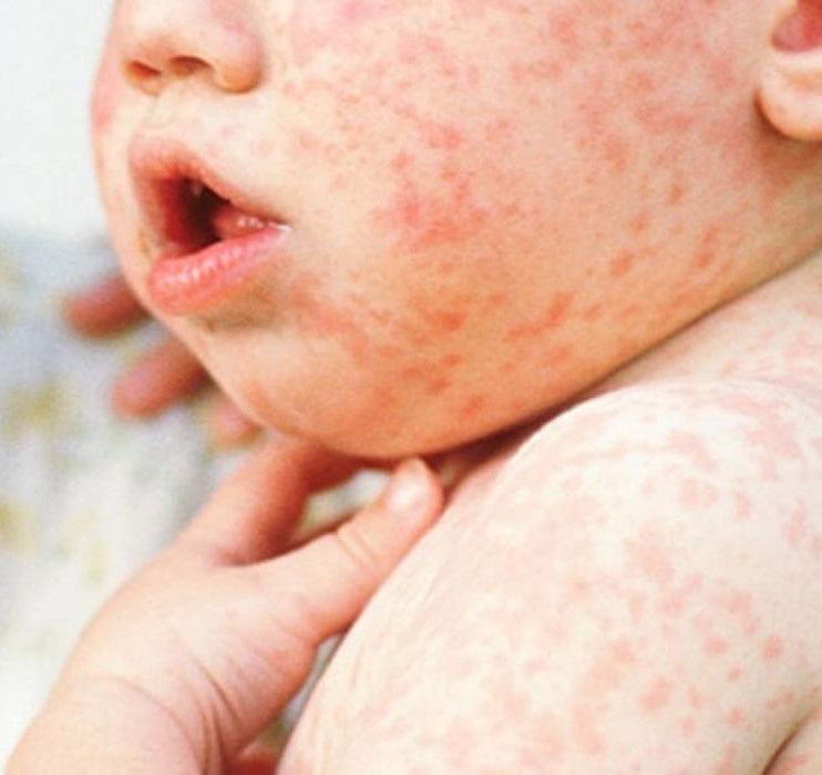 Ребенок, больной корью