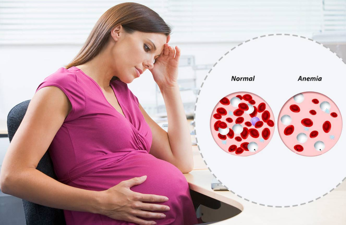 У беременной повышен. Железодефицитная анемия и беременность. Дефицит железа у беременных. Жда у беременных. Железодефицитная анемия и б.