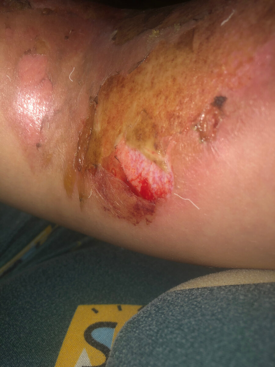 Это 3 день после ожога, начнём с того как меня лечили в нашей доблестной больнице, я приехала мне обработали перекисью и обмотали всю обгоревшую часть обмоченной марлей и бинтом, и сказали сушить феном в следущий раз придти через 2 дня я пришла мне отодрали бинт с половиной обожженной кожи…. Это было очень больно!!!! И опять по старой техники мне все замотали, пришла опять через 2 дня на перевязку, мне сделали все тоже самое, в этот момент спустилась заведующая отделения на проверку, спросила у меня все обстоятельства я ей все рассказала и оказалось что мне должны были сразу снять обожженную кожу чтоб не было шрамов….но мне этого не сделали, она взялась исправлять все за своими работниками, это было жестоко так как обожженная когда уже прислала к мясу, мне отодрали потом у меня началось загноенное моего ожога, я размазала дома бинт и решила что он так быстрее подсинит чем с бинтом, и это было правильном так у меня начало заживать намного быстрее. 