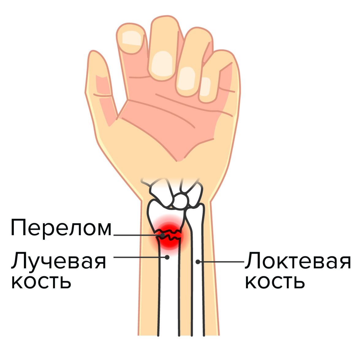 Диагноз перелом руки