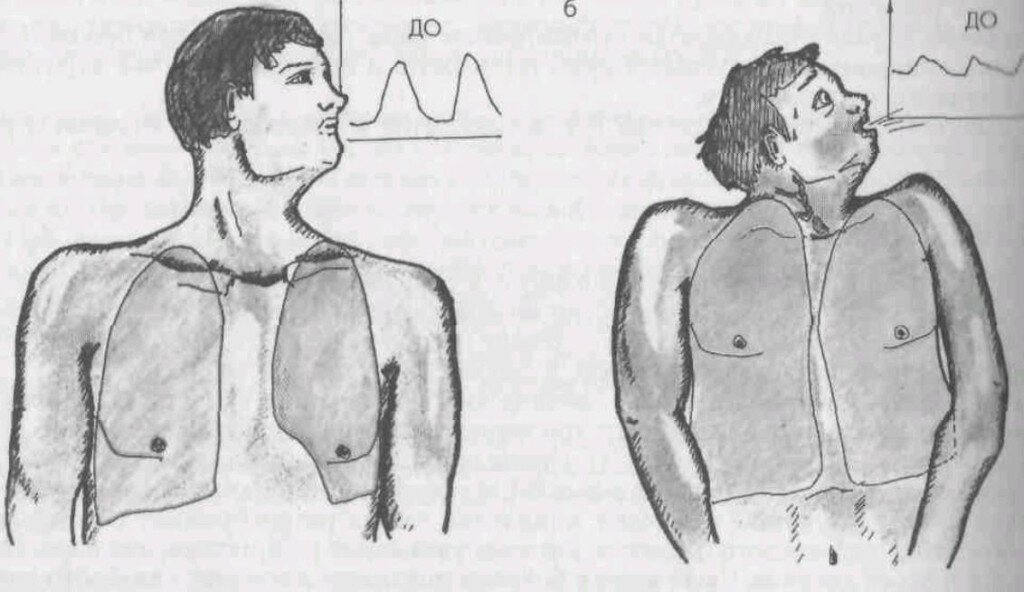 Легкие растут. Куда деваться сердцу?