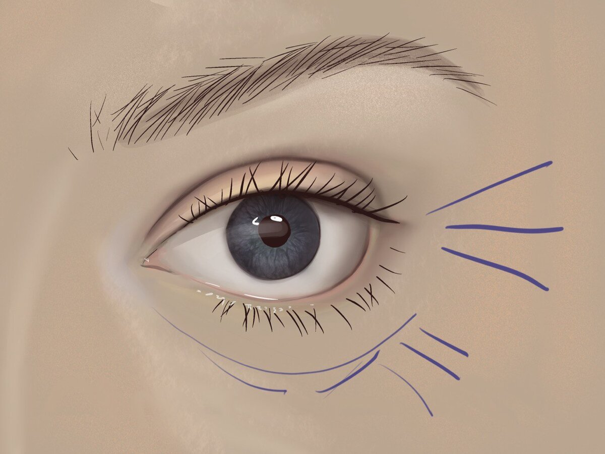 Причины появления морщин вокруг глаз — как этого избежать