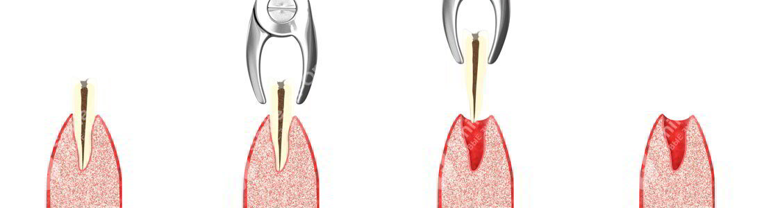 Почему не останавливается кровь после удаления зуба?