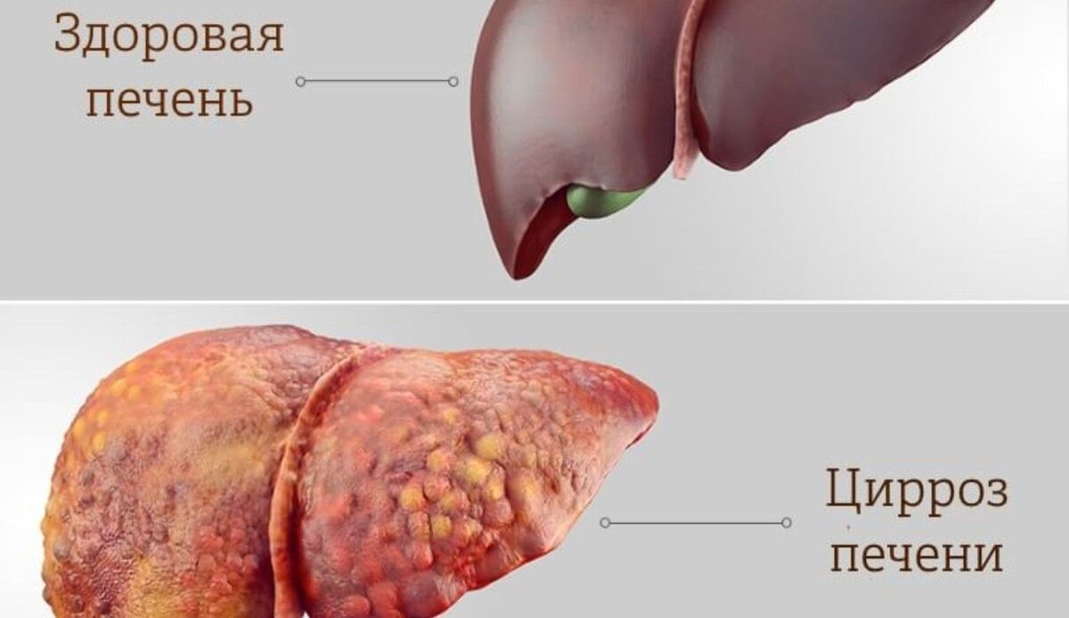 Барбарис обыкновенный ( листья ) - 10 г, зверобой продырявленный ( трава ) - 10 г, мята перечная ( трава ) - 10 г, тысячелистник обыкновенный - 10 г, хвощ полевой ( трава ) - 10 г, цикорий обыкновенный - 10 г, цмин песчаный ( цветы ) - 10 г. 1 лес.л. сырья на стакан кипятка, настоять 30 минут, процедить перед употреблением. Принимать по - 0,5 стакана 3  раза в день до еды в течение - 1/3 месяцев. При необходимости курс повторить через 3  месяца.