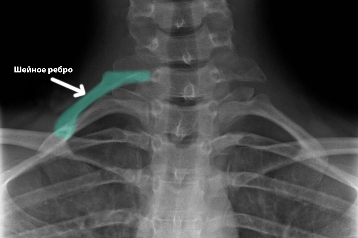 Шейные ребра. Дополнительное шейное ребро рентген. Шейные ребра с7 на рентгене. Добавочные шейные ребра с7. Добавочное шейное ребро рентген.