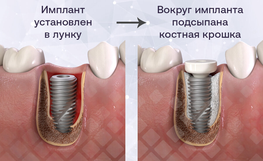 Импланты сколько болят