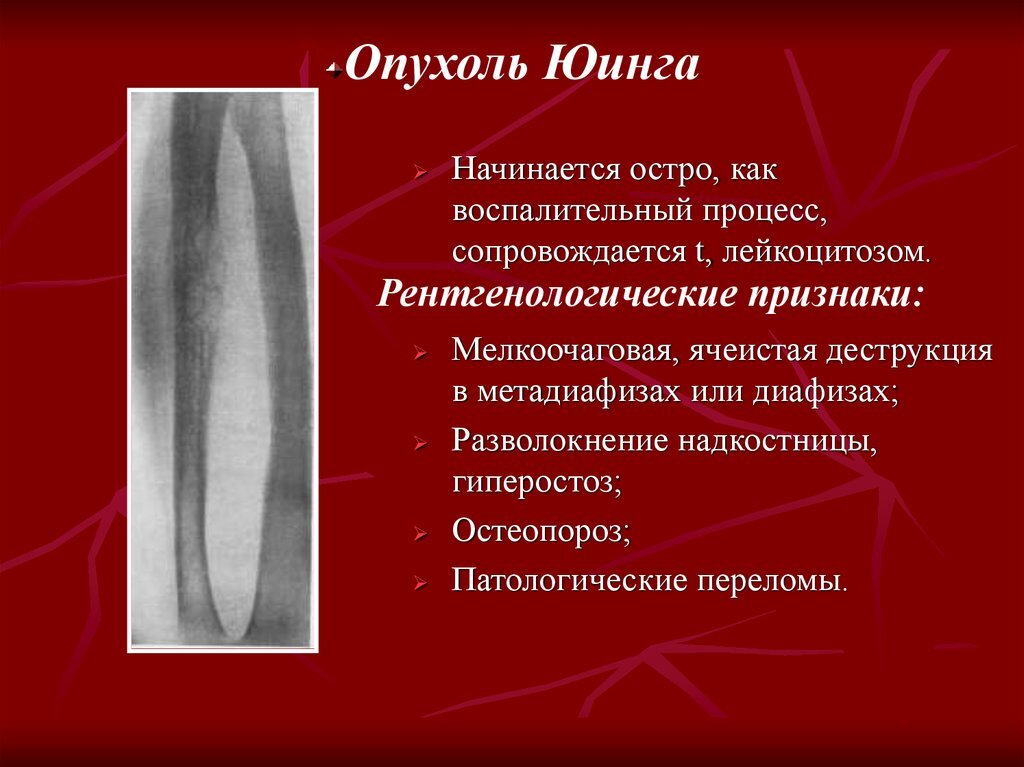 Саркома юинга симптомы. Опухоль Юинга на ногте.