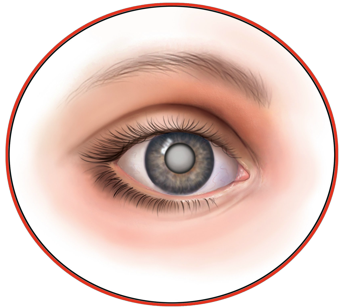 1 признаки катаракты