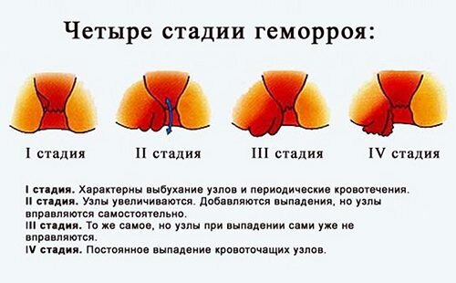 Что нельзя делать при геморрое - противопоказания