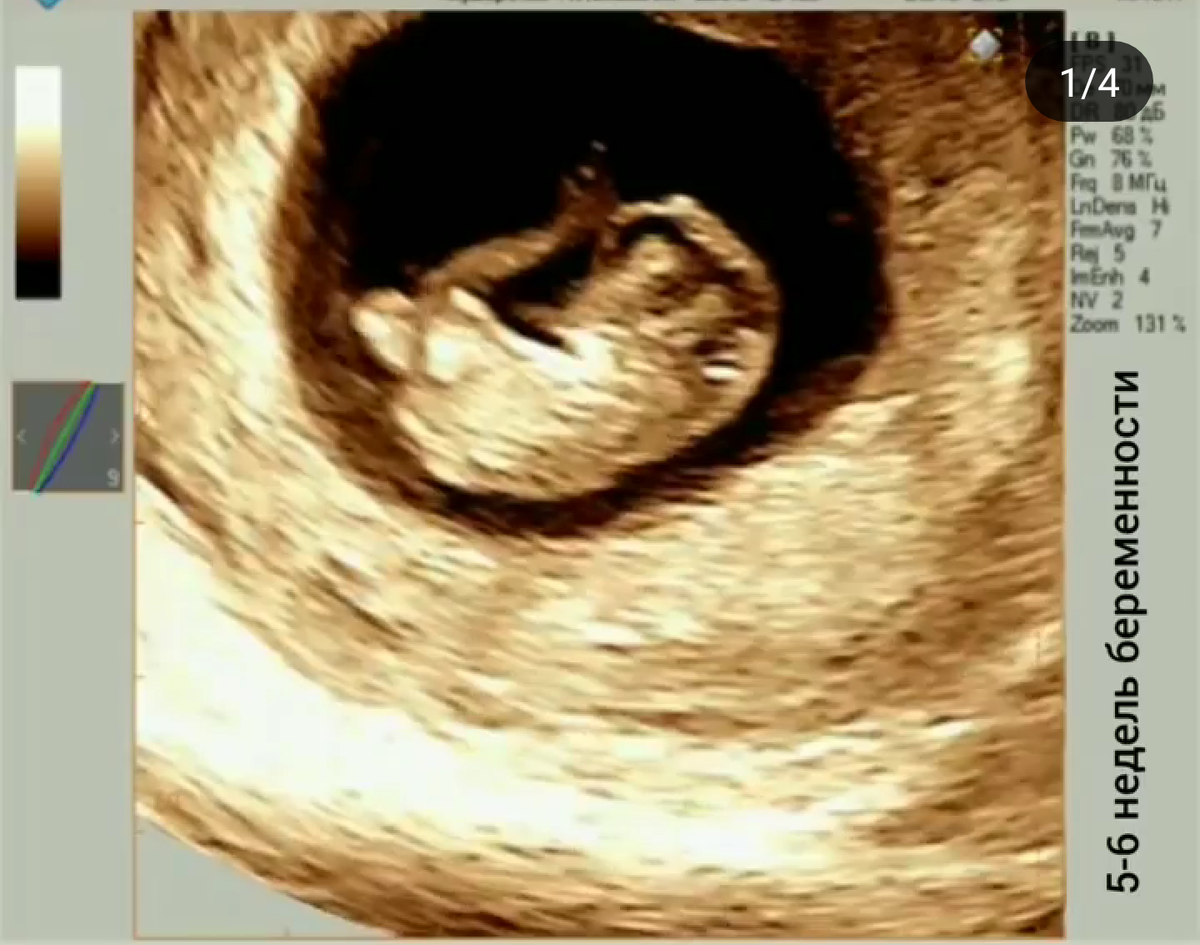 УЗИ 6 недель беременности видео