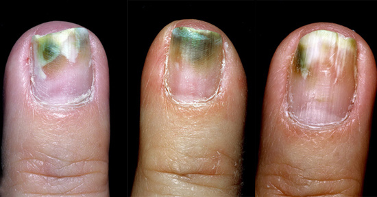 Не занимайтесь самолечением! Лечение микозов выльется Вам в немалую копеечку. При самолечении придется потраться вдвое больше.