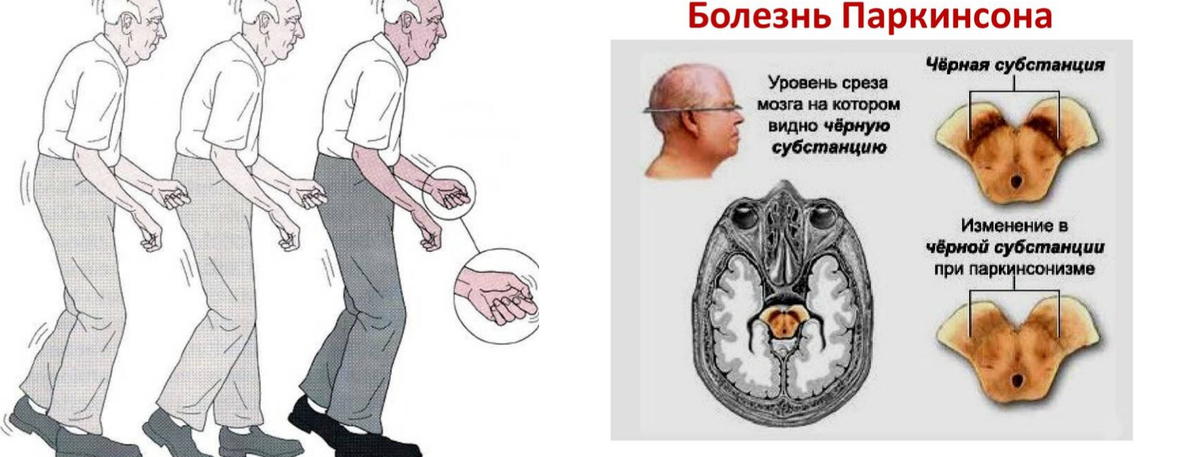 Пациенты с болезнью Паркинсона