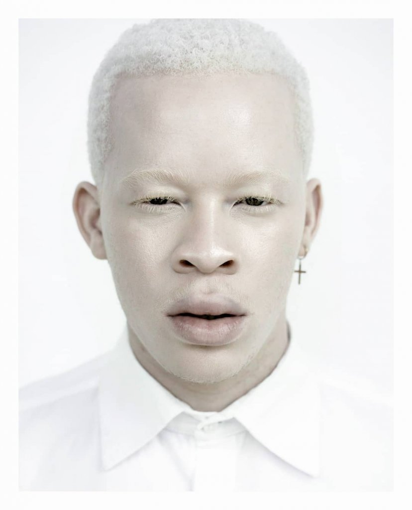 Альбинос человек фото мужчины