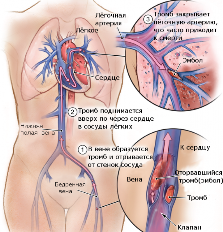 Тромба сердце причины. Схема тромбоэмболии легочной артерии. Тромб легочной артерии тромбоэмболия. Эмболия тромбоэмболия.