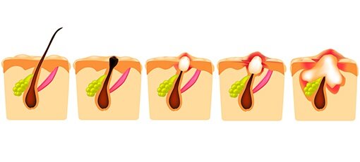 #прыщи на лице 