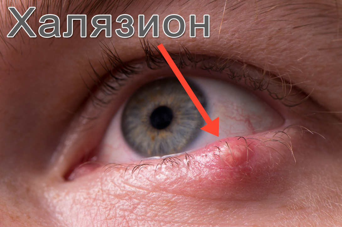 халязион