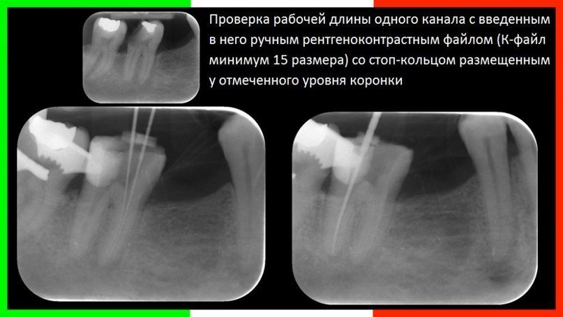 Определение корневых каналов. Измерение рабочей длины корневого канала. Рентгенологический метод определения длины корневого канала. Определение длины корневого канала. Длина корневых каналов.