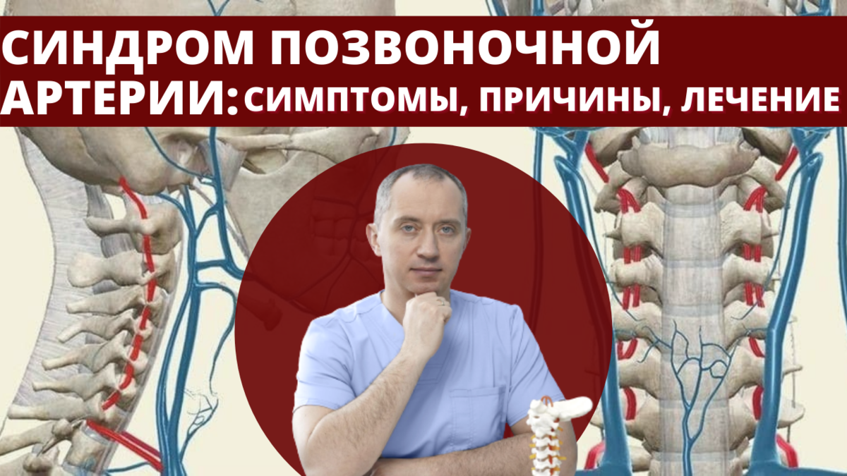 Синдром позвоночной артерии код по мкб 10. Синдром позвоночной артерии. Синдром позвоночной артерии упражнения. Упражнения при синдроме позвоночной артерии.