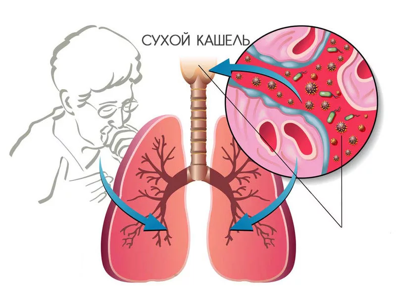 Чем успокоить кашель, как быстро снять приступы влажного и сухого кашля