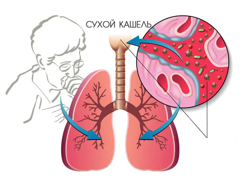 Кашель при гриппе та ОРВИ - ПЕКТОЛВАН