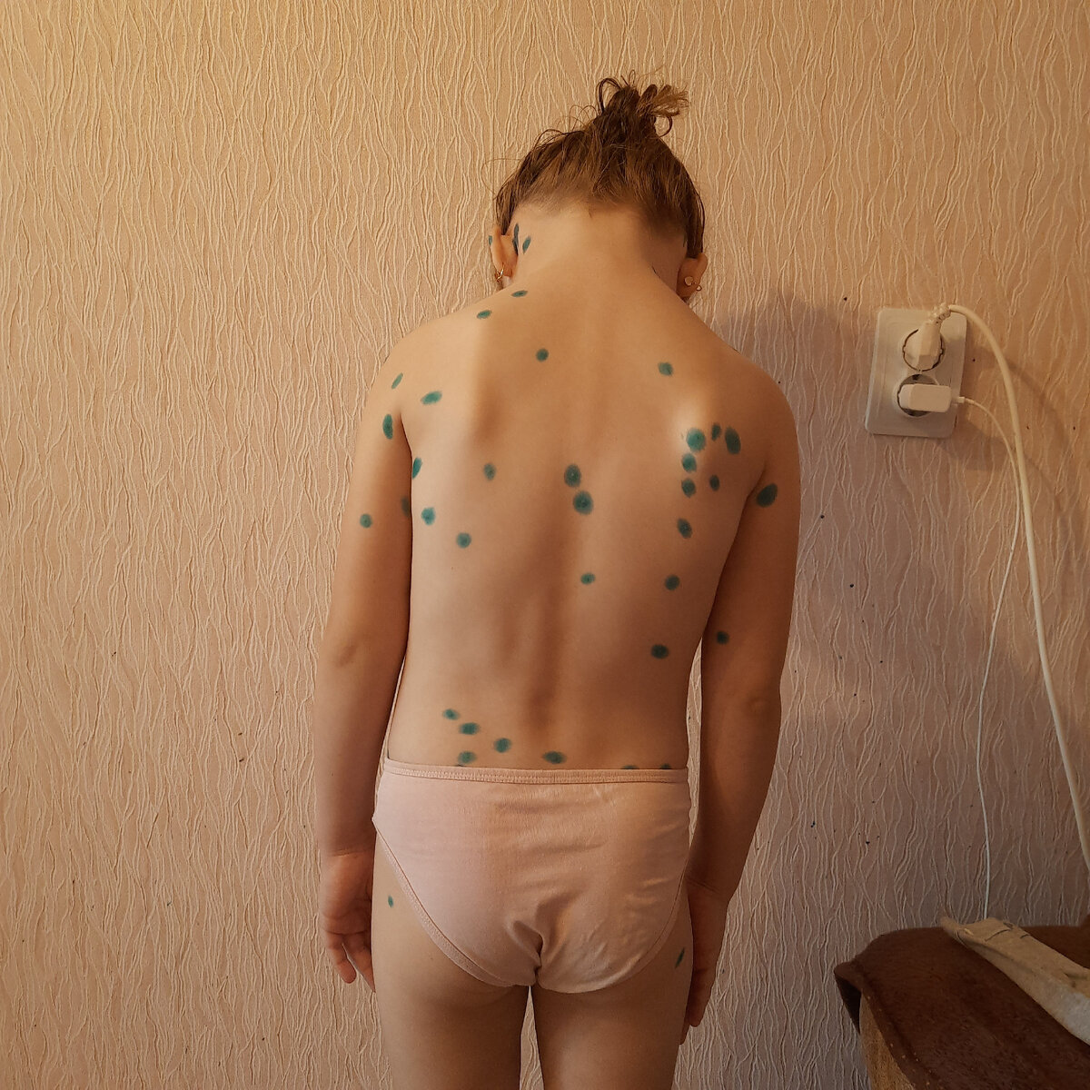 Первый день ветрянки