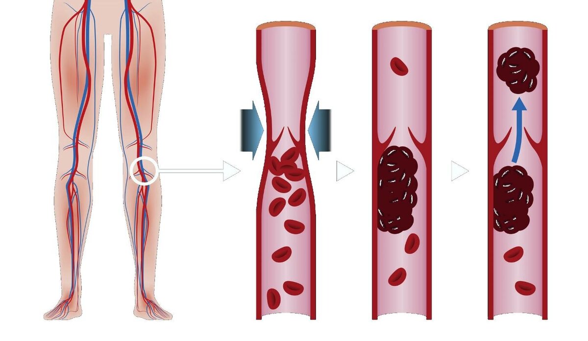 Осторожно: тромб! Как его вовремя заметить? | Клиника «Нева» | Дзен