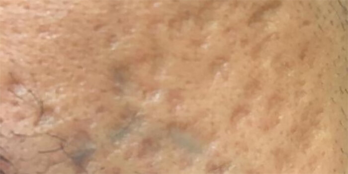 acne.org