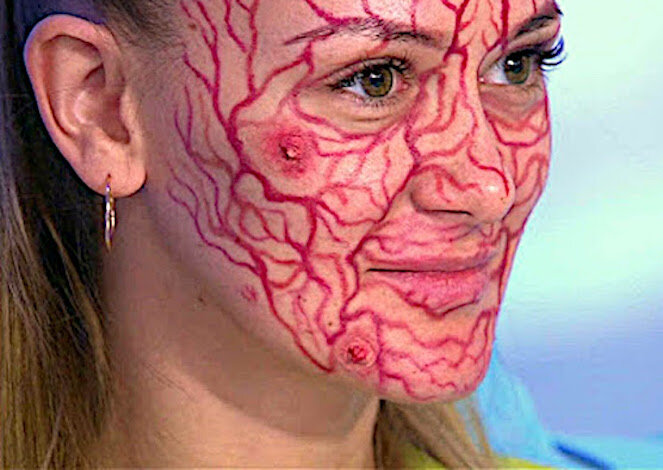 Милиумы на лице - причины и лечение, как убрать белые угри на лице