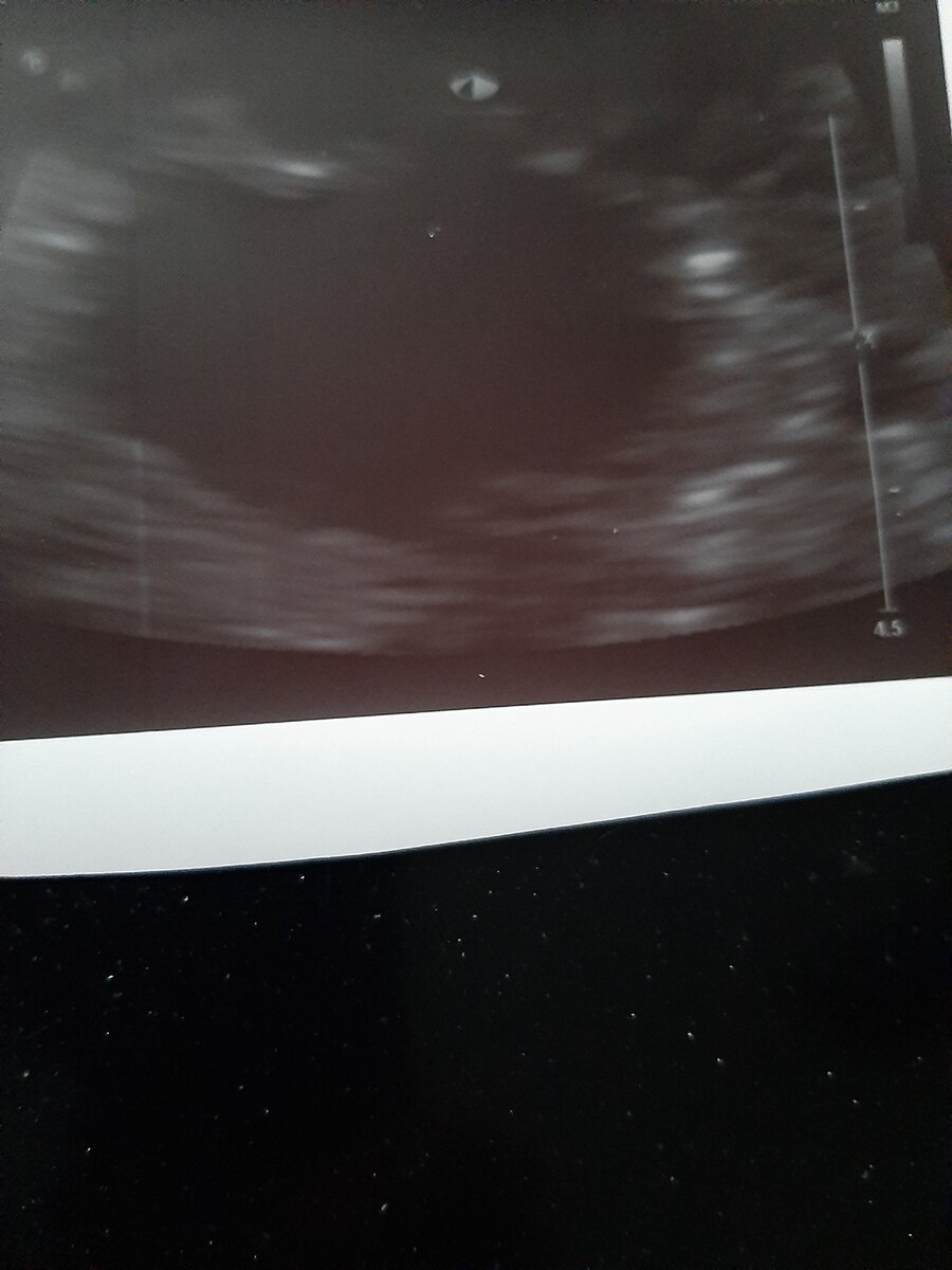 Лютеиновая киста. Выглядит не очень характерно: имеет довольно однородное содержимое ( нет  выраженной характерной" паутинчатой взвеси") .Обьемом 20 мл-средняя .Фото из личного архива автора.