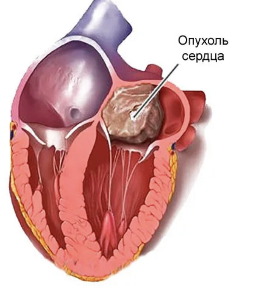 Образование левого предсердия. Опухоль сердца миксома. Миксома сердца операция. Доброкачественная опухоль сердца миксома.