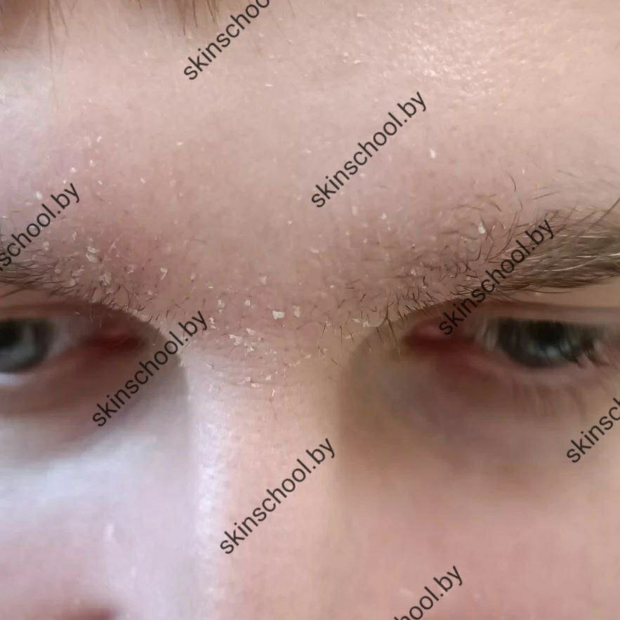 Себорейный дерматит лица | Советы дерматолога|Sovetydermatologa | Дзен
