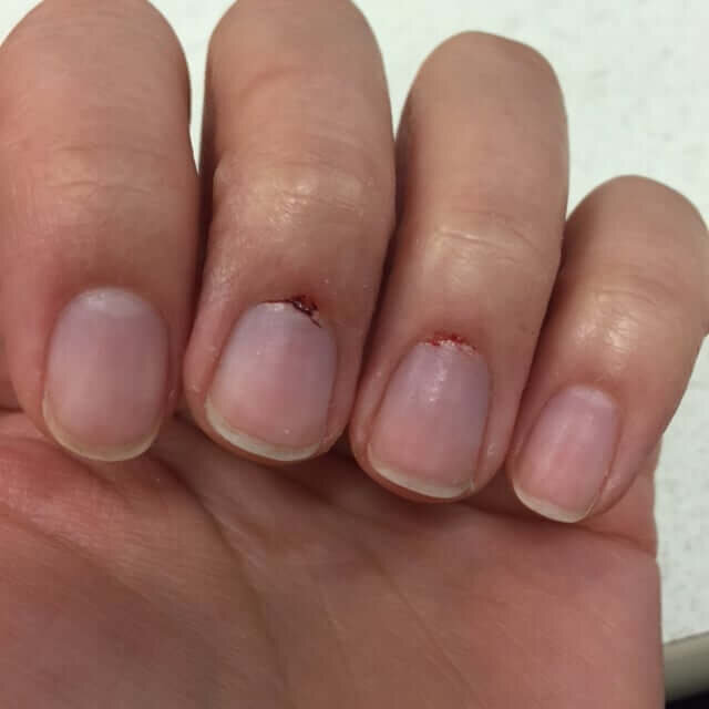 Кровоточащая область у кутикулы