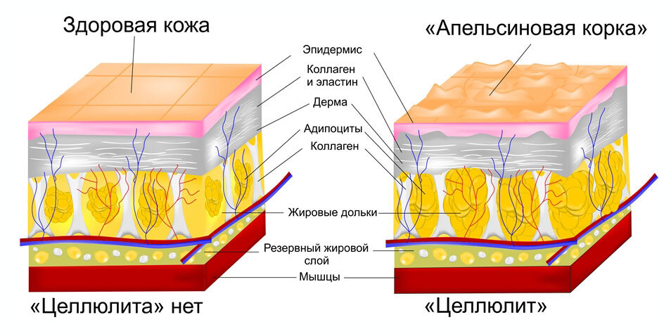 Сравнение подкожно-жировой клетчатки при целлюлите и без него