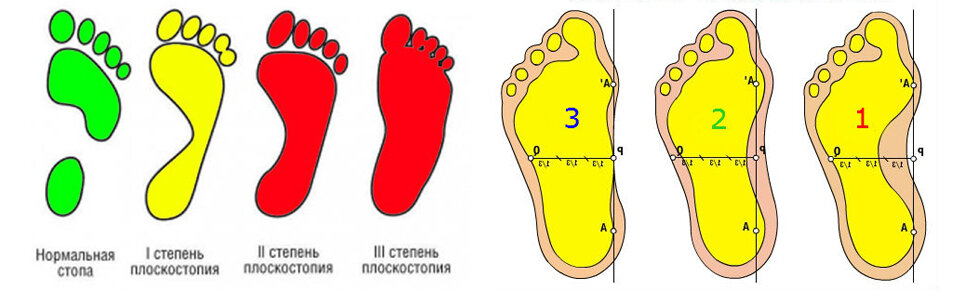 Как выглядит плоскостопие у ребенка
