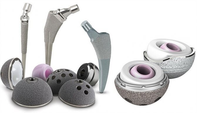 Виды и типы эндопротезов