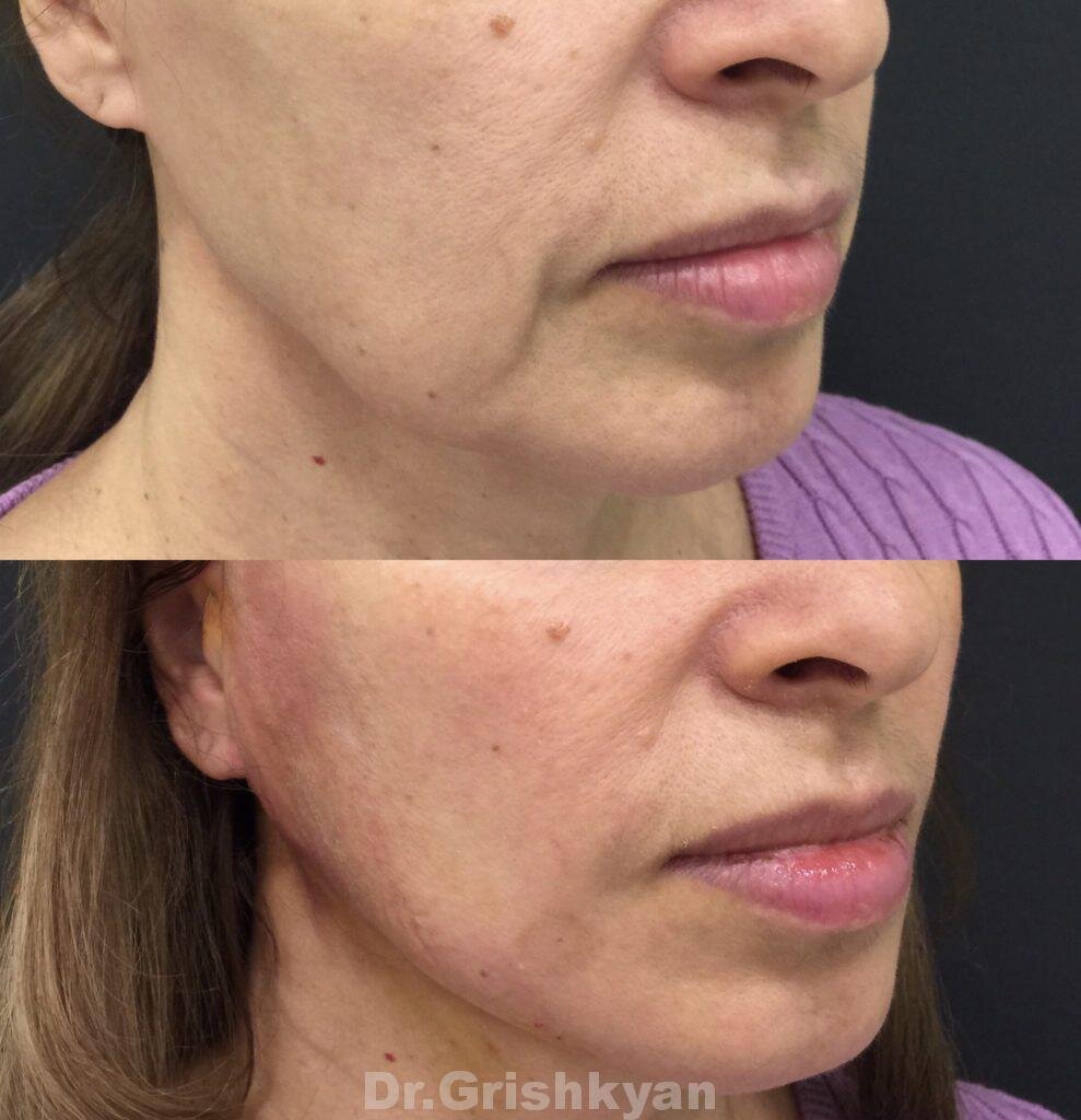 Фото до и после подтяжки нитями. Фото с сайта Д.Р. Гришкяна. Имеются противопоказания, требуется консультация специалиста