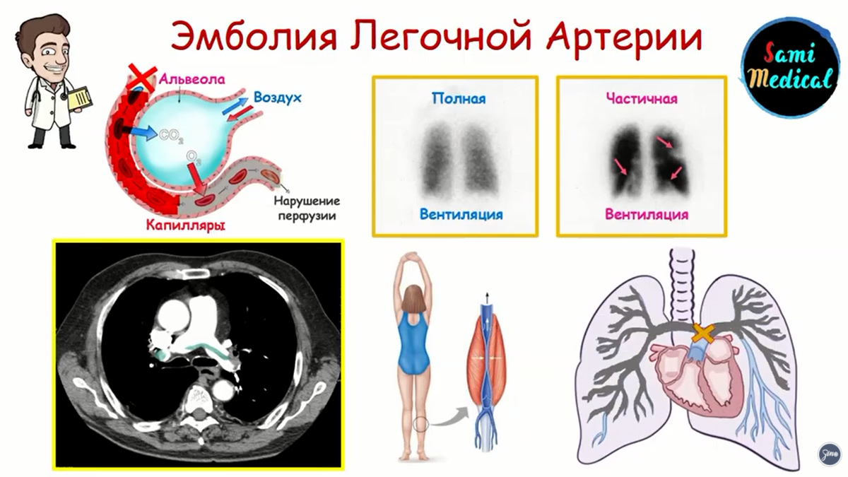 Эмболия шок. Эмболия легочной артерии. Тромбоэмболия легочной артерии. Тромбоэмболия легочной артерии клиника. Клиника тромбоэмболии легочной артерии (Тэла).