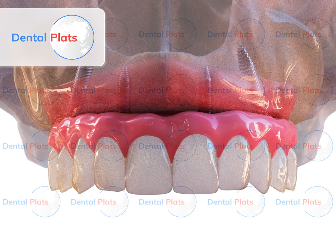 All-on-4 — нам необходимо всего четыре имплантата и 12 часов, для того чтобы вернуть улыбку мечты.