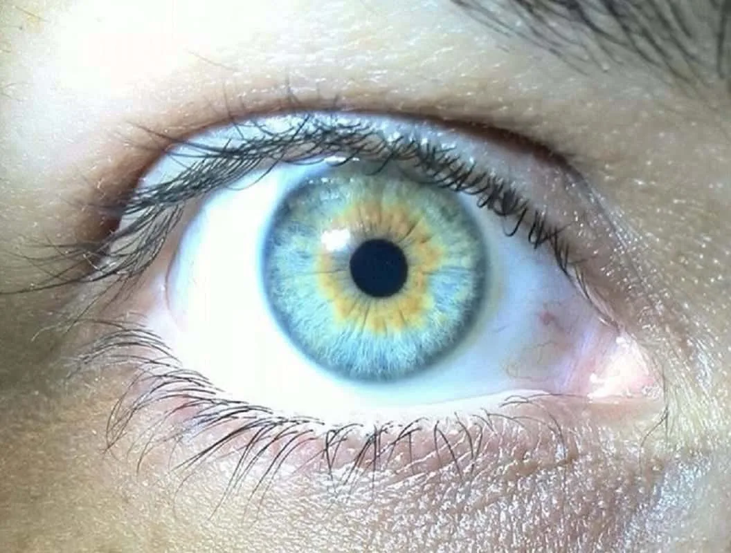 Желтые пятна на радужке глаза. Центральная гетерохромия зеленый Карий. Центральная гетерохромия Радужки глаз. Центральная гетерохромия глаз Карий и зеленый. Центральная гетерохромия голубых глаз.